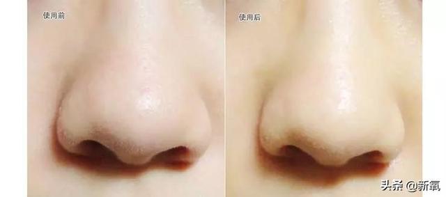 怎么去黑頭小竅門（手把手教你有效去黑頭的方法）(2)