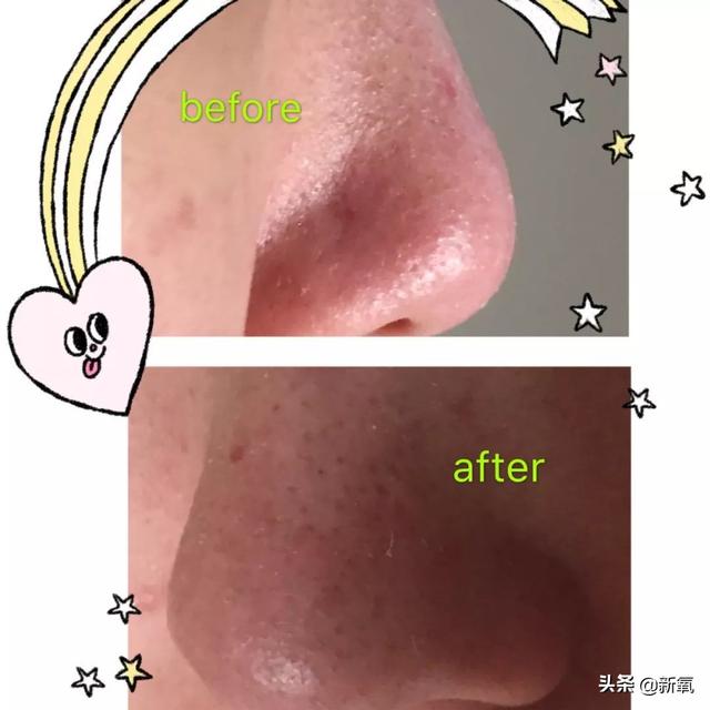怎么去黑頭小竅門（手把手教你有效去黑頭的方法）(8)