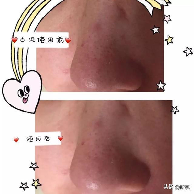 怎么去黑頭小竅門（手把手教你有效去黑頭的方法）(9)