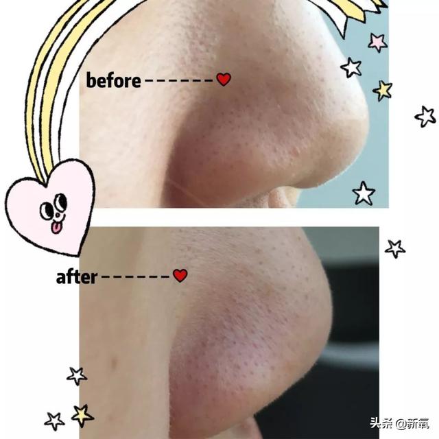 怎么去黑頭小竅門（手把手教你有效去黑頭的方法）(14)