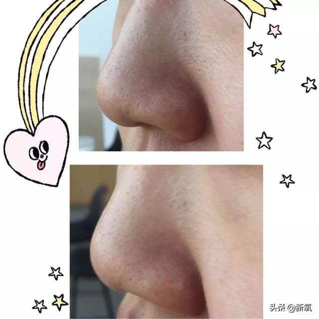 怎么去黑頭小竅門（手把手教你有效去黑頭的方法）(15)