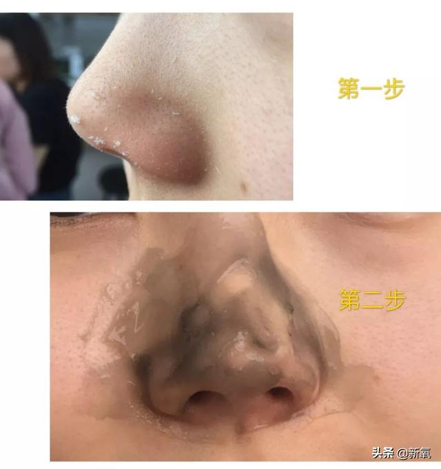 怎么去黑頭小竅門（手把手教你有效去黑頭的方法）(18)