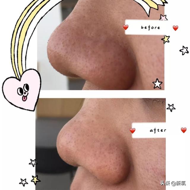 怎么去黑頭小竅門（手把手教你有效去黑頭的方法）(22)
